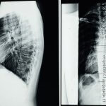 Radiografía de una espalda con escoliosis