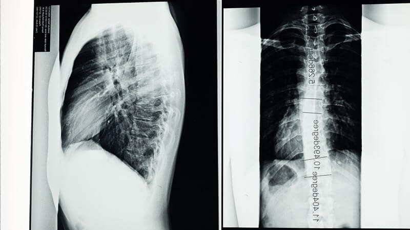 Quiromasaje y escoliosis: beneficios y recomendaciones