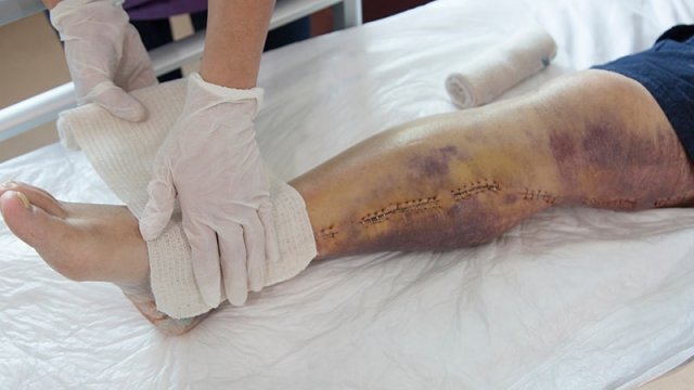 Pierna con edema tras una operación