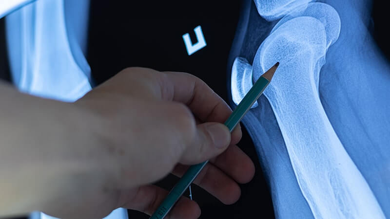 Masaje como terapia complementaria para esclerosis múltiple